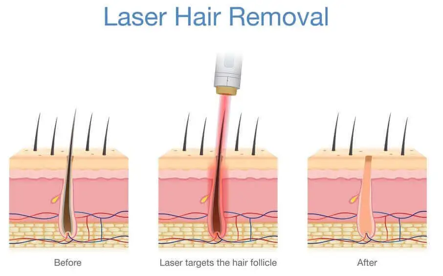 Laser Hair Removal